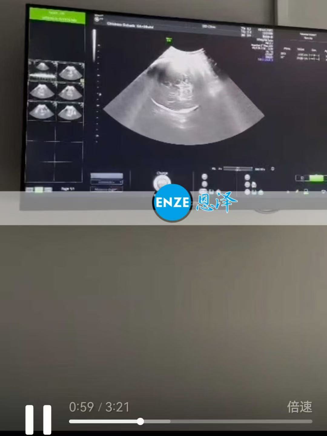 格鲁吉亚试管婴儿助孕爱心使者36周产检顺利过关