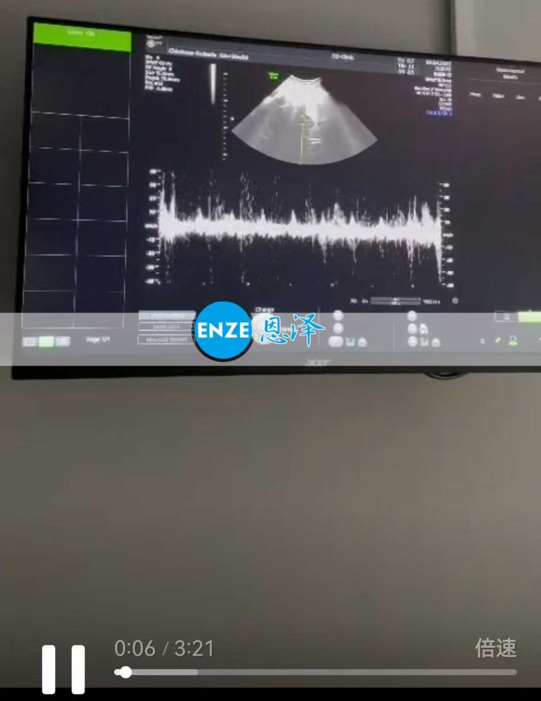 格鲁吉亚试管婴儿助孕爱心使者36周产检顺利过关