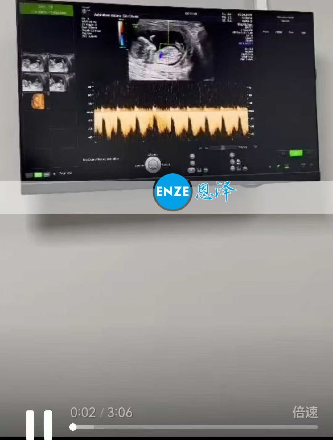 格鲁吉亚试管婴儿助孕爱心使者顺利度过风险期