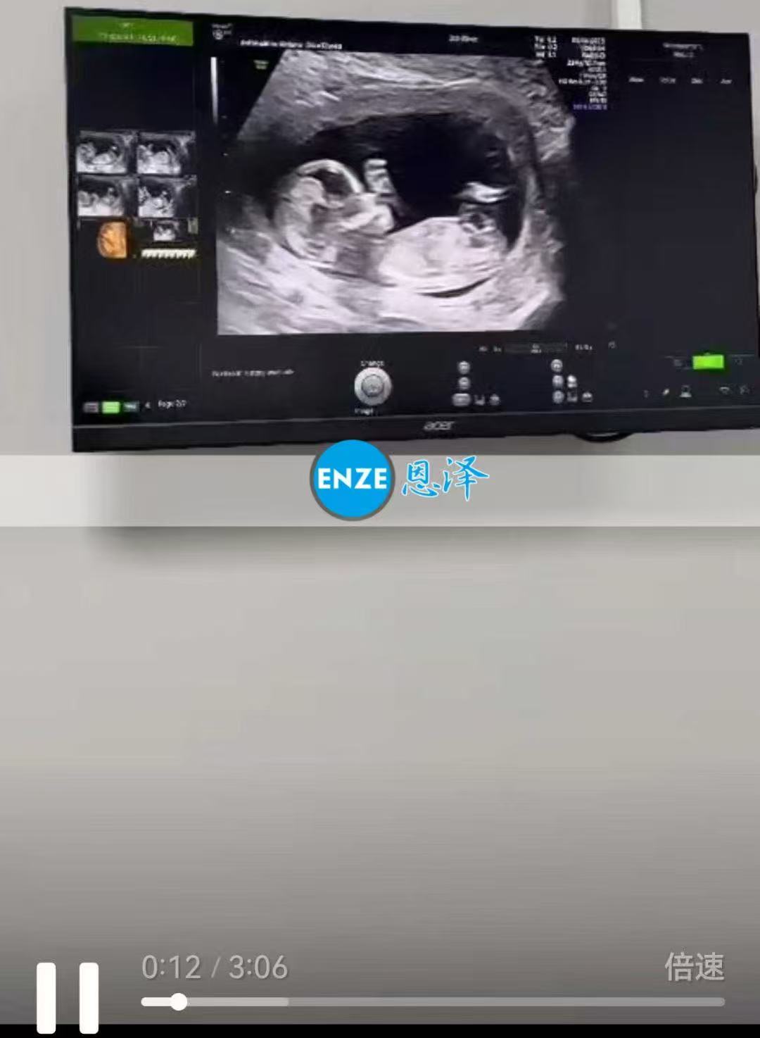 格鲁吉亚试管婴儿助孕爱心使者顺利度过风险期