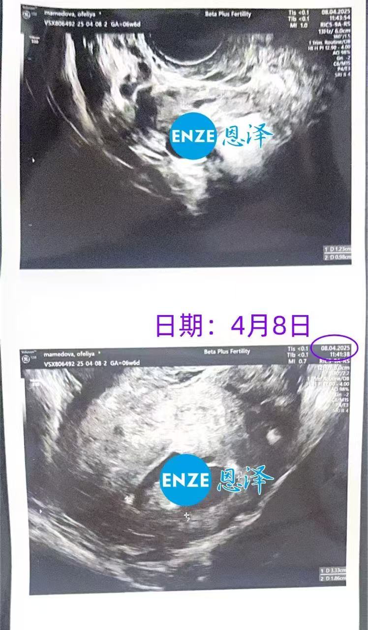 格鲁吉亚试管婴儿助孕爱心使者6周产检成功通过