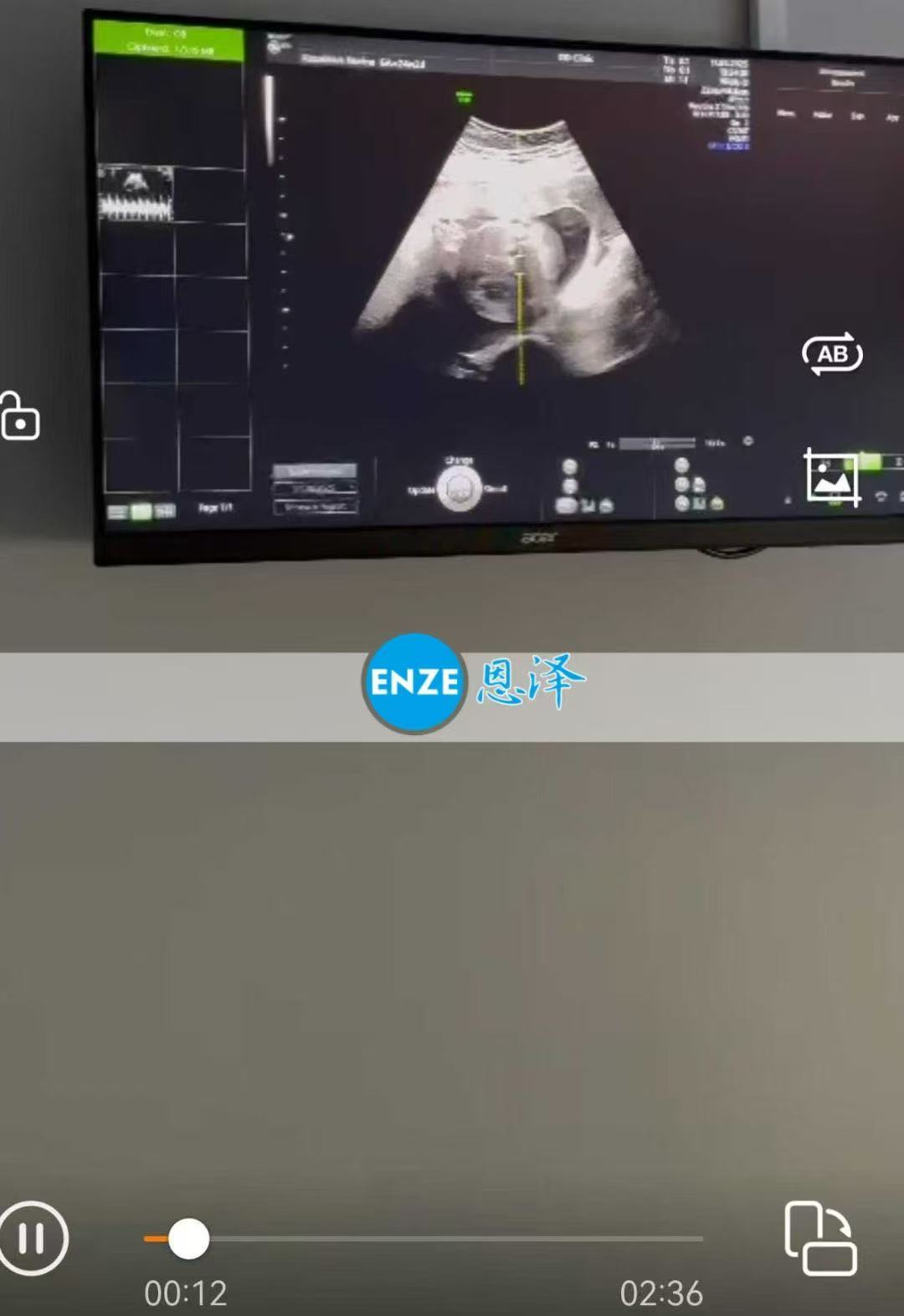 格鲁吉亚试管婴儿助孕爱心使者24周产检顺利通过