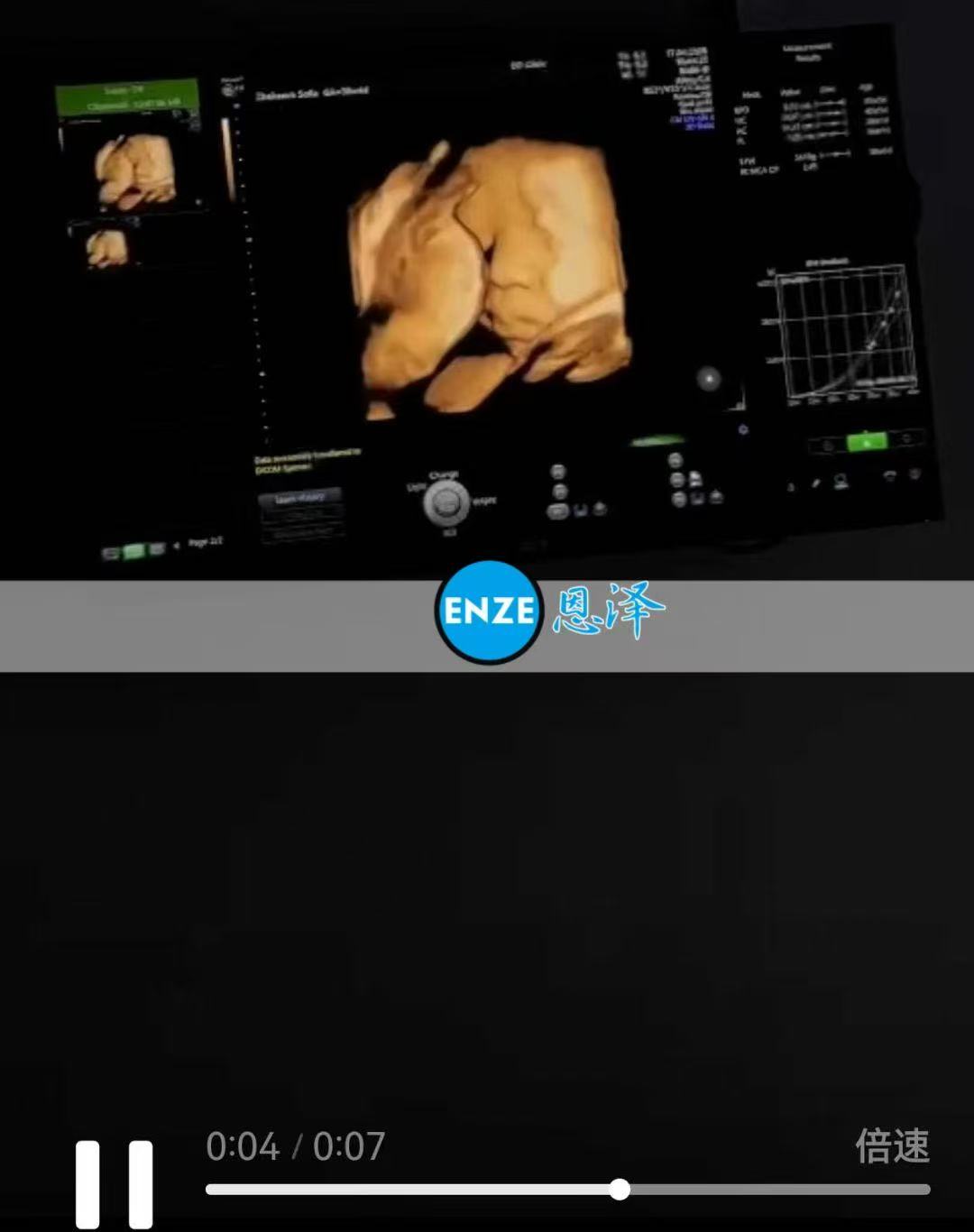 格鲁吉亚试管婴儿助孕爱心使者38周产检顺利，安心待产