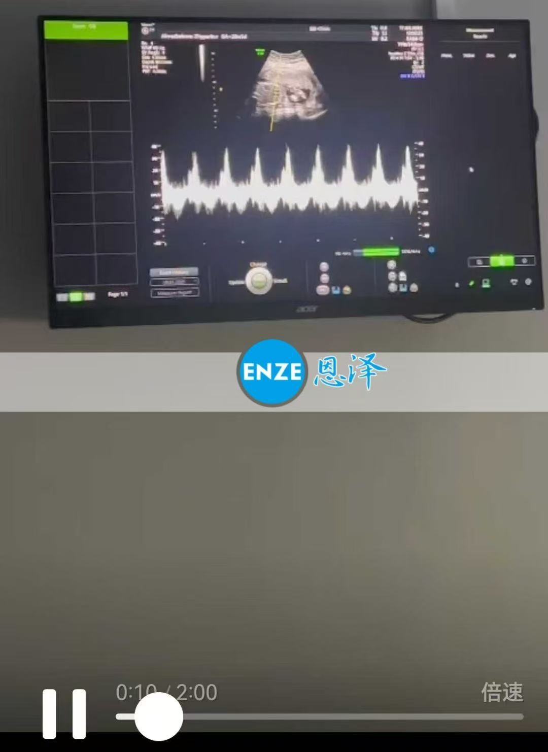 格鲁吉亚试管婴儿助孕爱心使者20周产检顺利通过