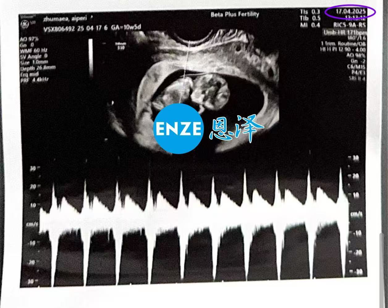 格鲁吉亚试管婴儿助孕爱心使者10周产检顺利过关