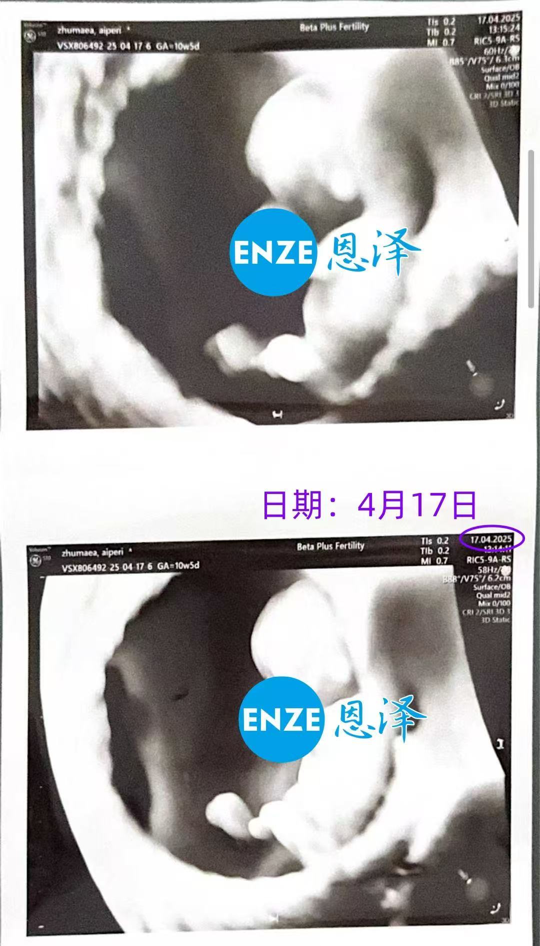 格鲁吉亚试管婴儿助孕爱心使者10周产检顺利过关
