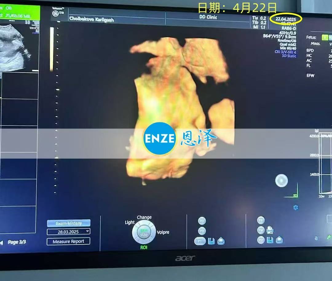 格鲁吉亚试管婴儿助孕爱心使者28周产检顺利通过