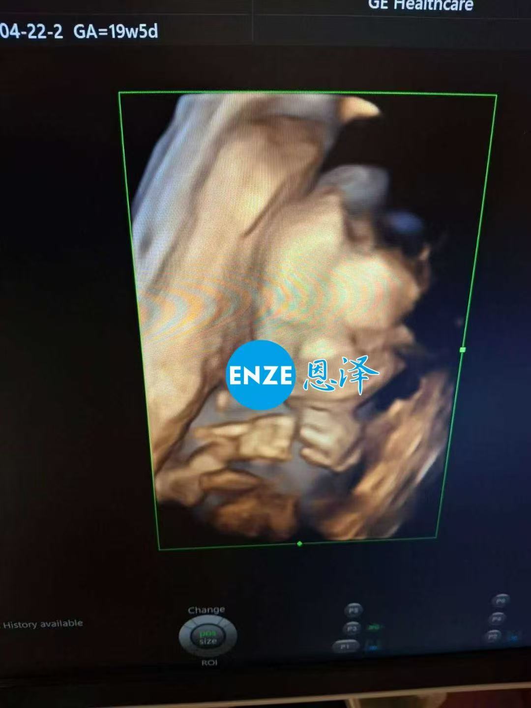 乌克兰试管婴儿助孕爱心使者19周产检顺利通过
