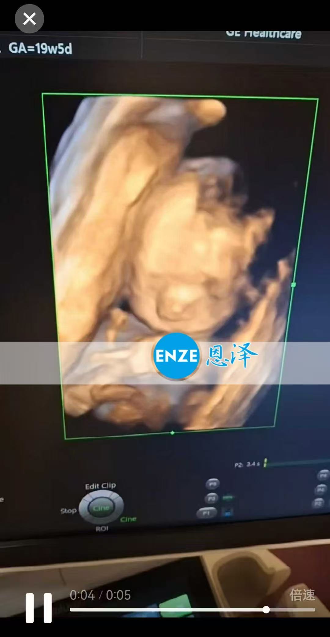 乌克兰试管婴儿助孕爱心使者19周产检顺利通过