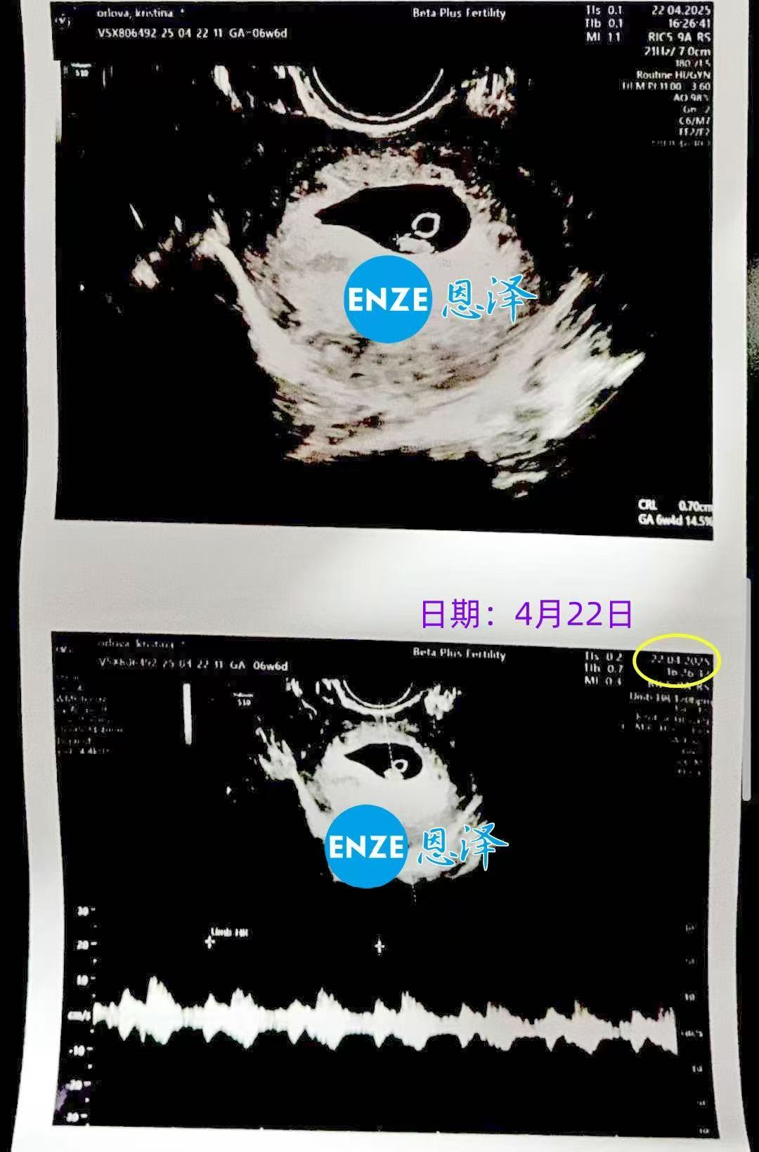 格鲁吉亚试管婴儿助孕爱心使者首检确认双胎报到