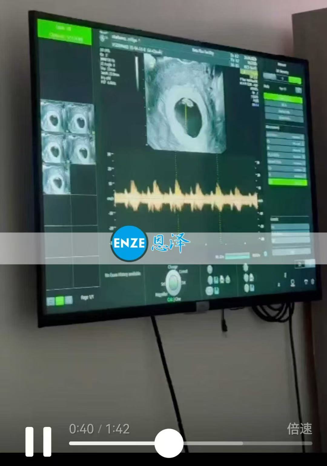 格鲁吉亚试管婴儿助孕爱心使者6周首检顺利通过