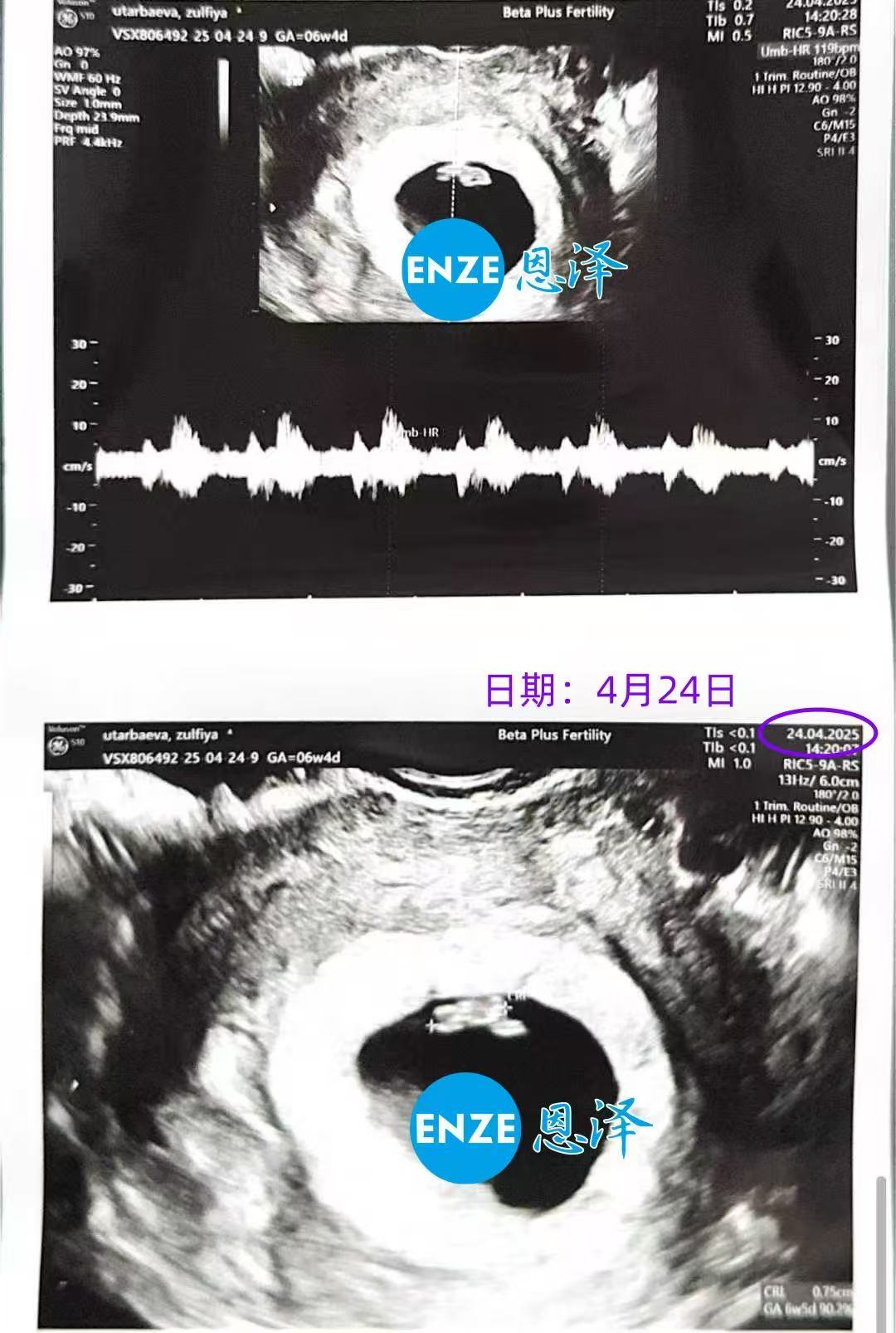 格鲁吉亚试管婴儿助孕爱心使者6周首检顺利通过