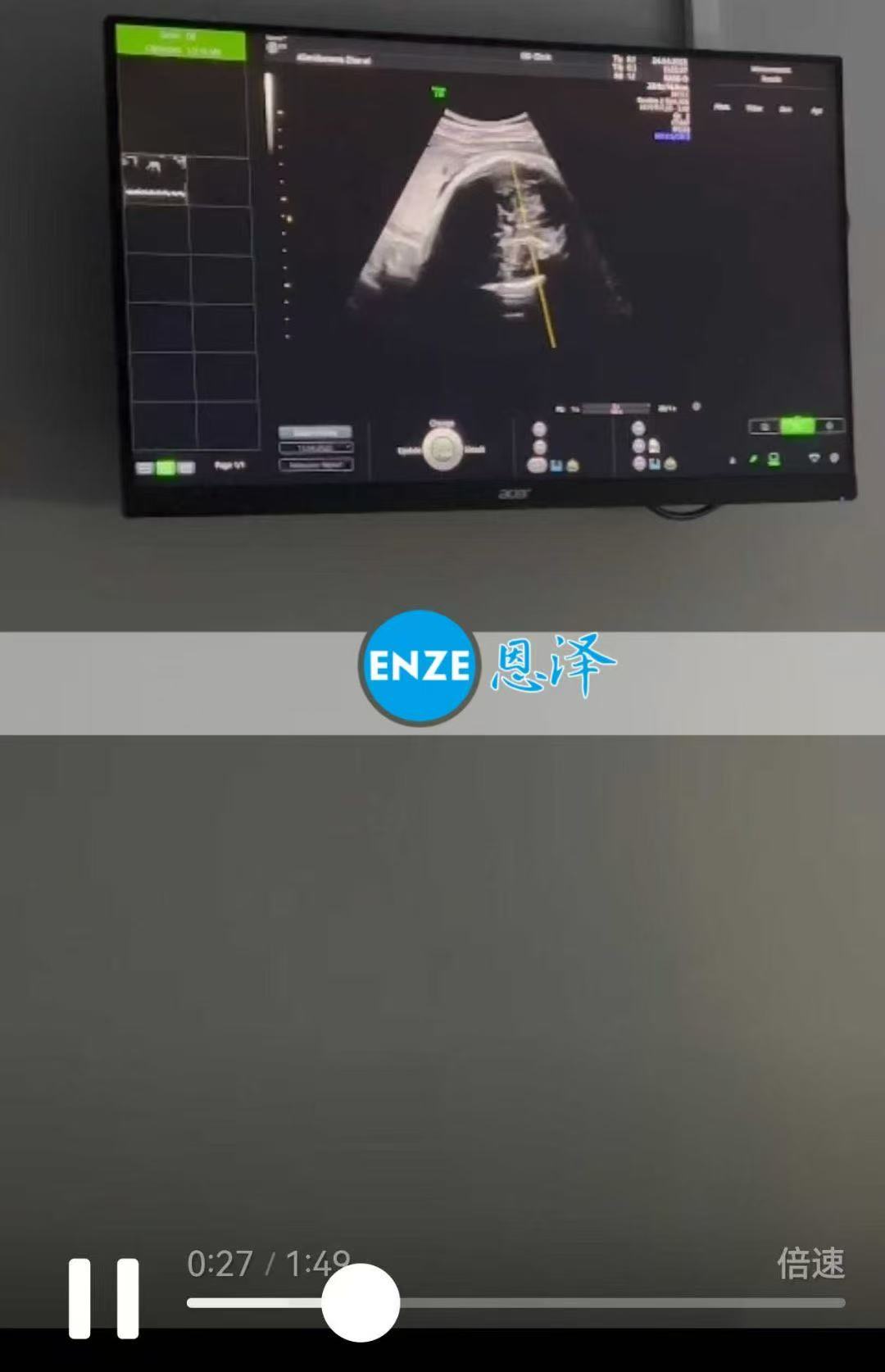 格鲁吉亚试管婴儿助孕爱心使者35周产检顺利过关
