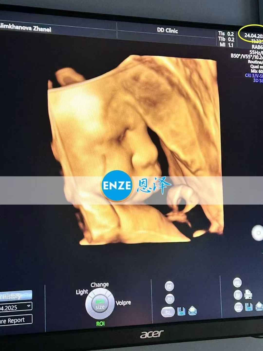 格鲁吉亚试管婴儿助孕爱心使者35周产检顺利过关