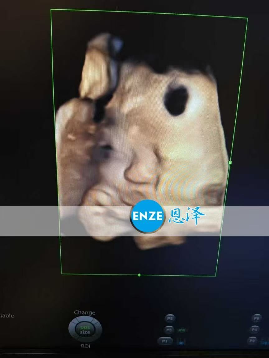 乌克兰试管婴儿助孕爱心使者产检顺利，静待宝贝降生