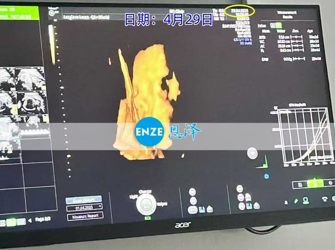 格鲁吉亚试管婴儿助孕爱心使者30周产检顺利通过