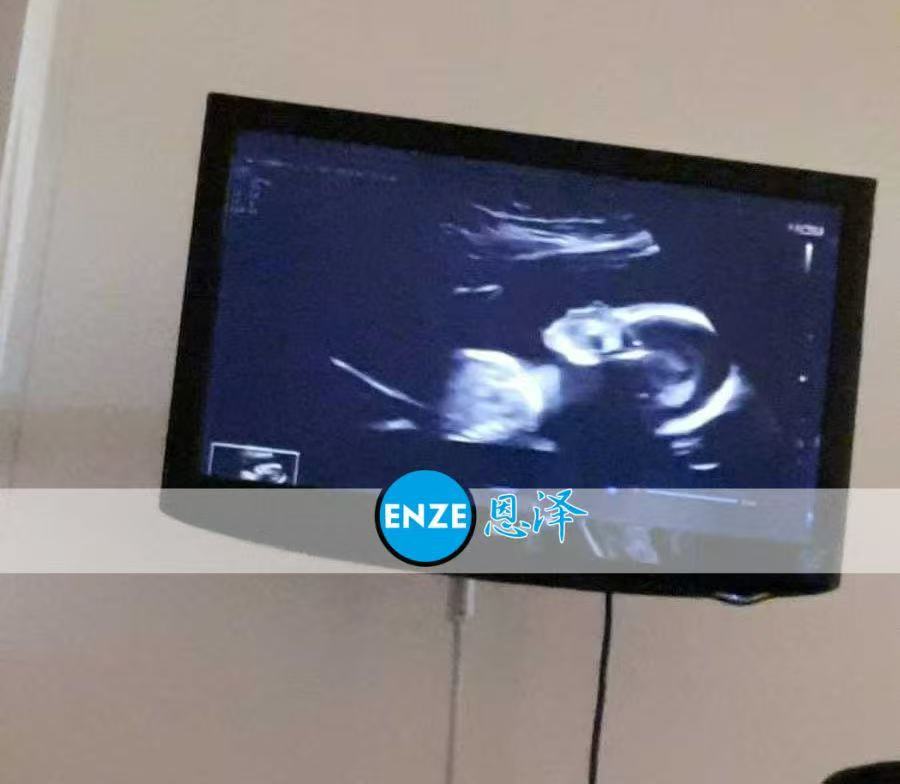 格鲁吉亚试管婴儿助孕爱心使者20周产检顺利通过