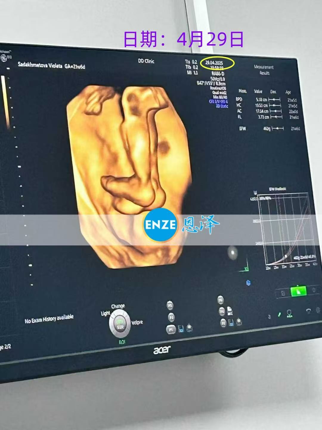 格鲁吉亚试管婴儿助孕爱心使者21周产检顺利通过