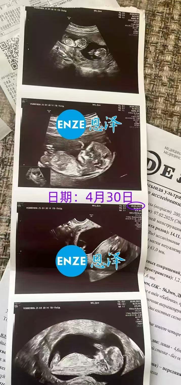 格鲁吉亚试管婴儿助孕爱心使者12周产检顺利通过