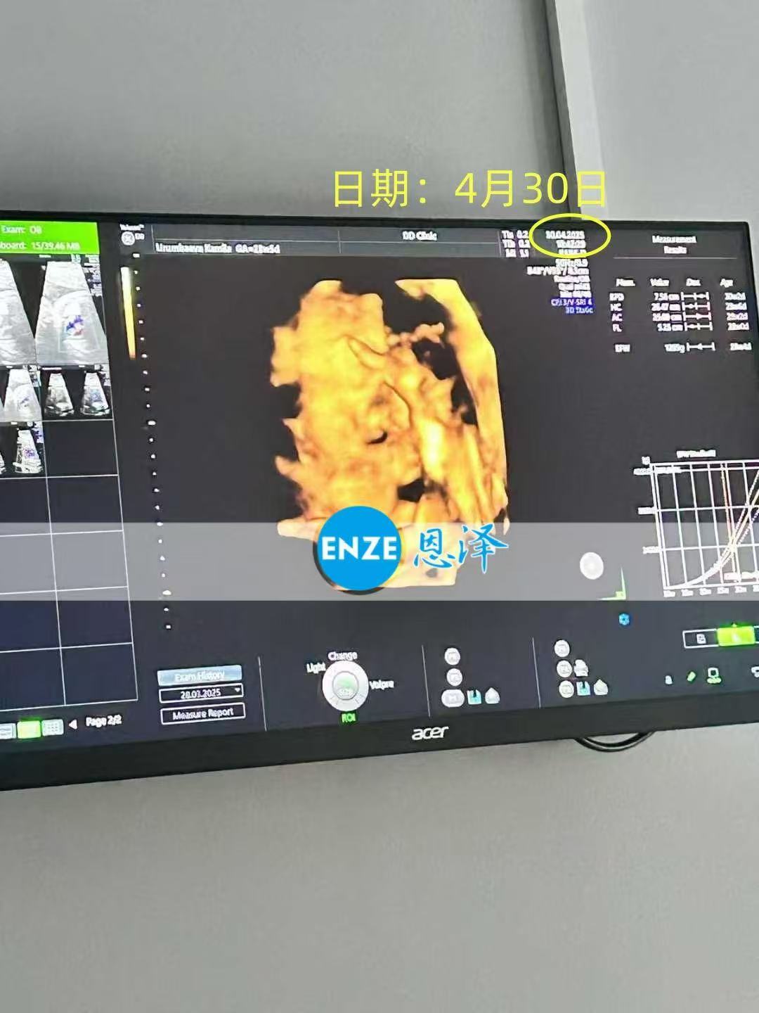 格鲁吉亚试管婴儿助孕爱心使者28周产检顺利过关