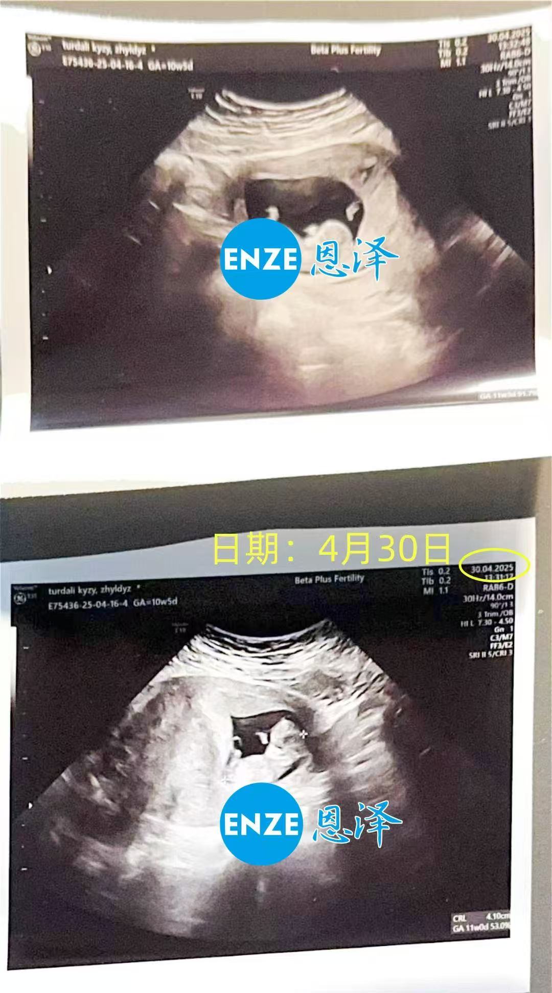 格鲁吉亚试管婴儿助孕爱心使者成功通过10周产检