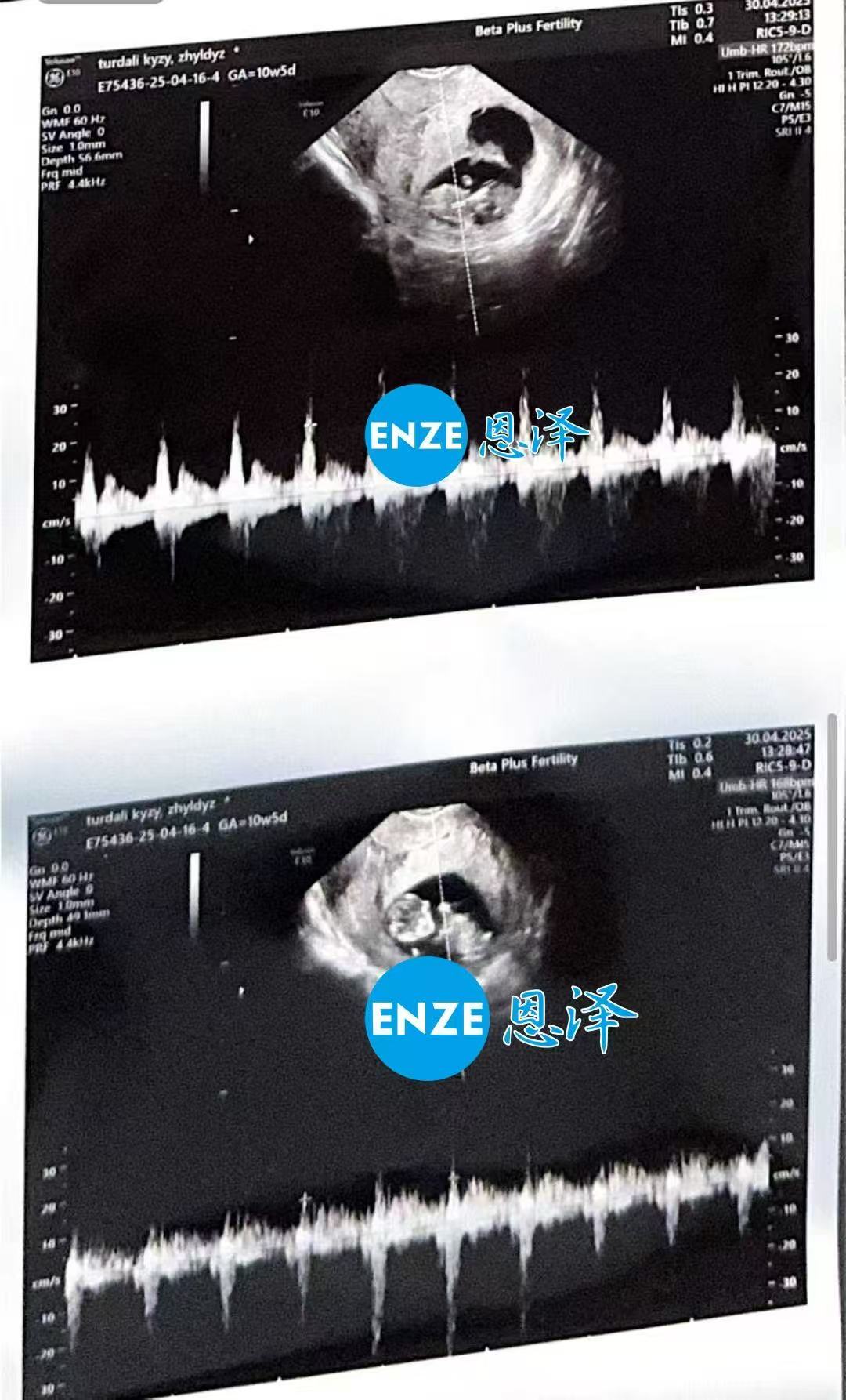 格鲁吉亚试管婴儿助孕爱心使者成功通过10周产检