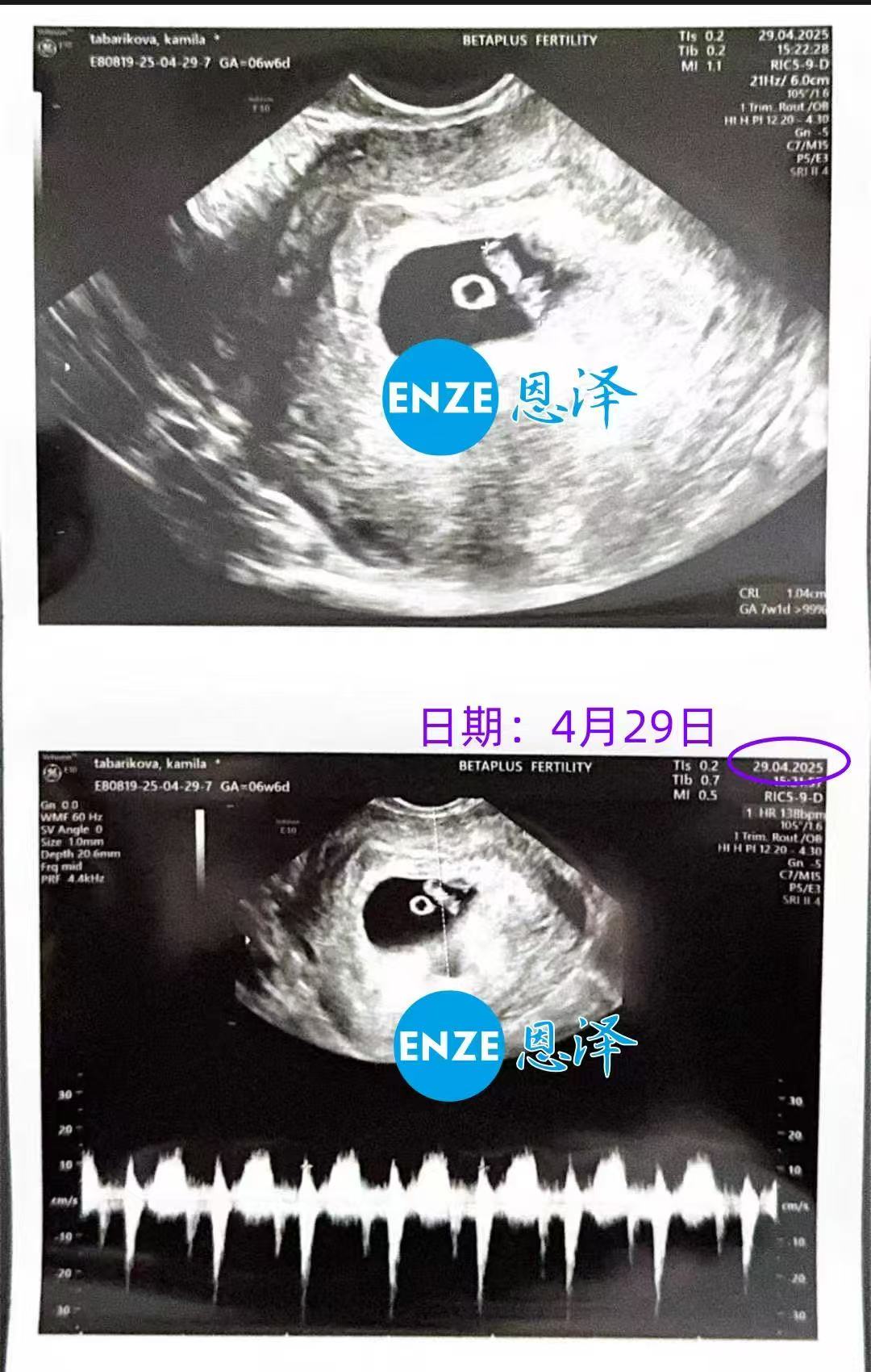 格鲁吉亚试管婴儿助孕爱心使者6周首检顺利过关