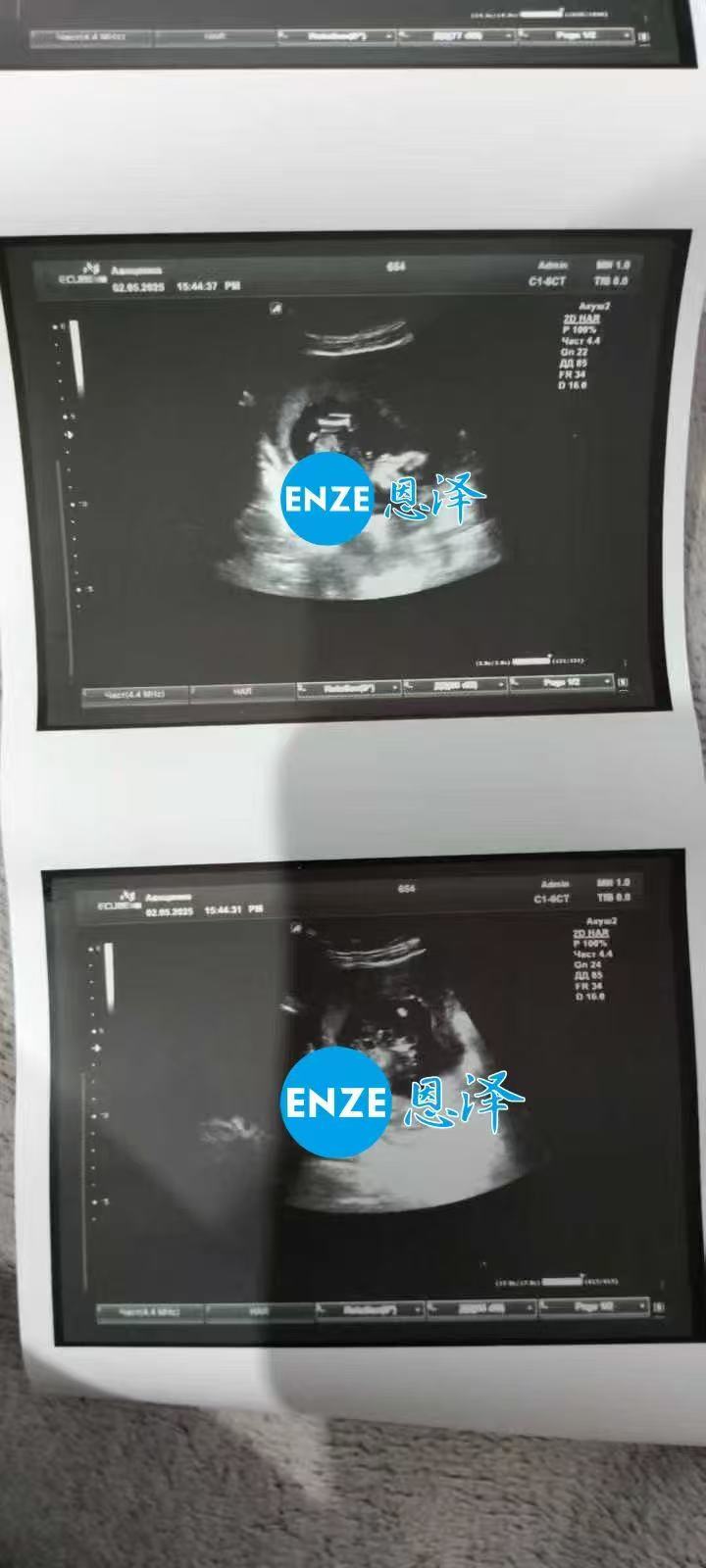 格鲁吉亚试管婴儿助孕爱心使者16周产检顺利通过