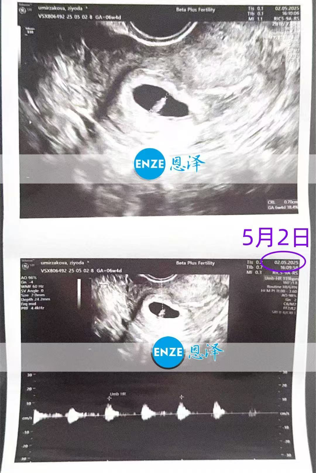 格鲁吉亚试管婴儿助孕爱心使者6周产检顺利过关