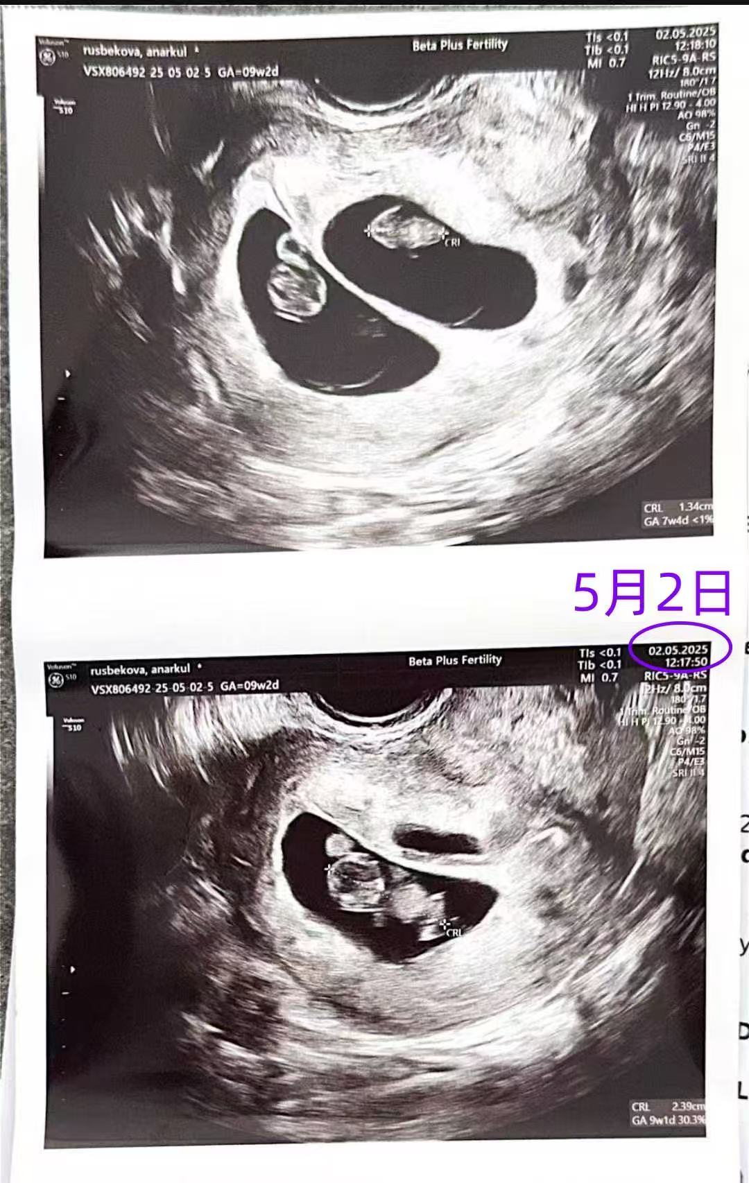 格鲁吉亚试管婴儿助孕爱心使者9周产检顺利过关