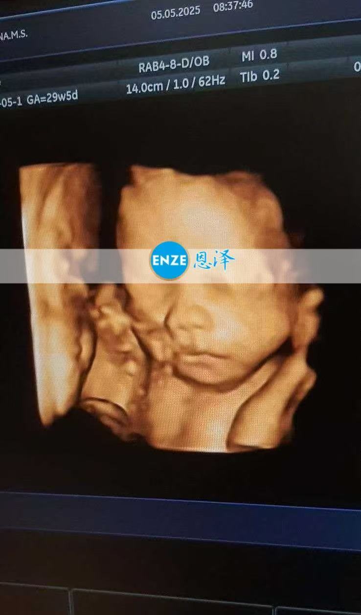 乌克兰试管婴儿助孕爱心使者28周检查顺利过关