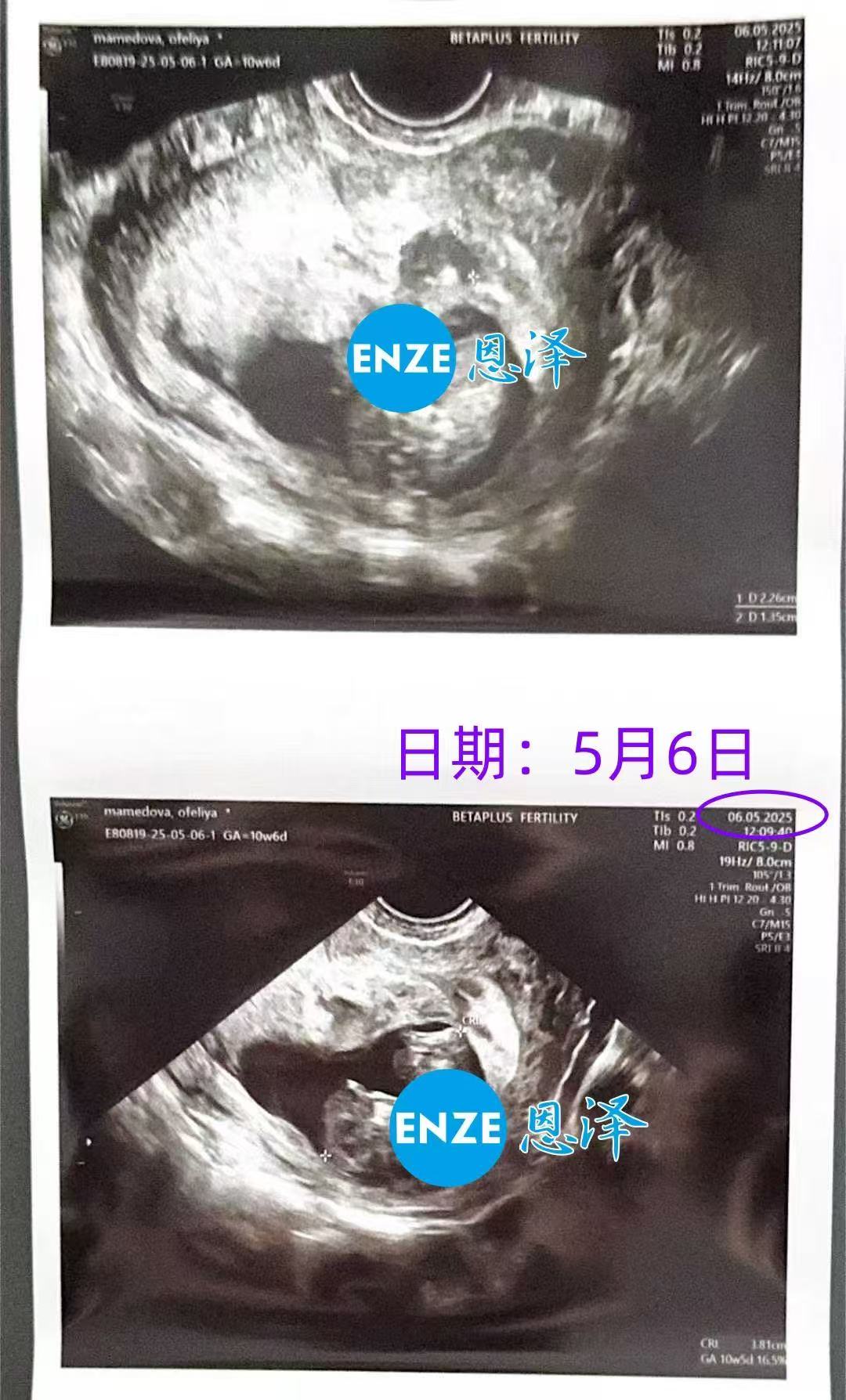 格鲁吉亚试管婴儿助孕爱心使者10周产检顺利通过