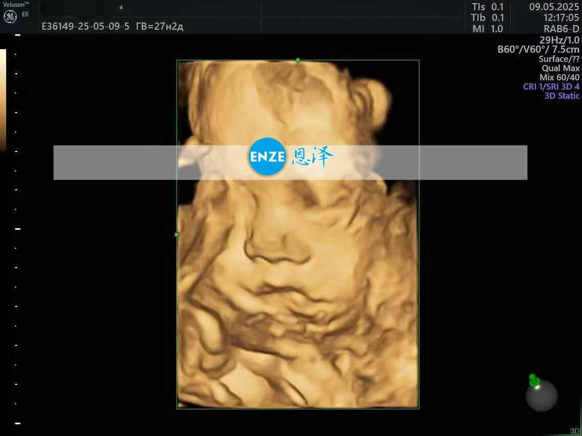 乌克兰试管婴儿助孕爱心使者27周产检顺利通过
