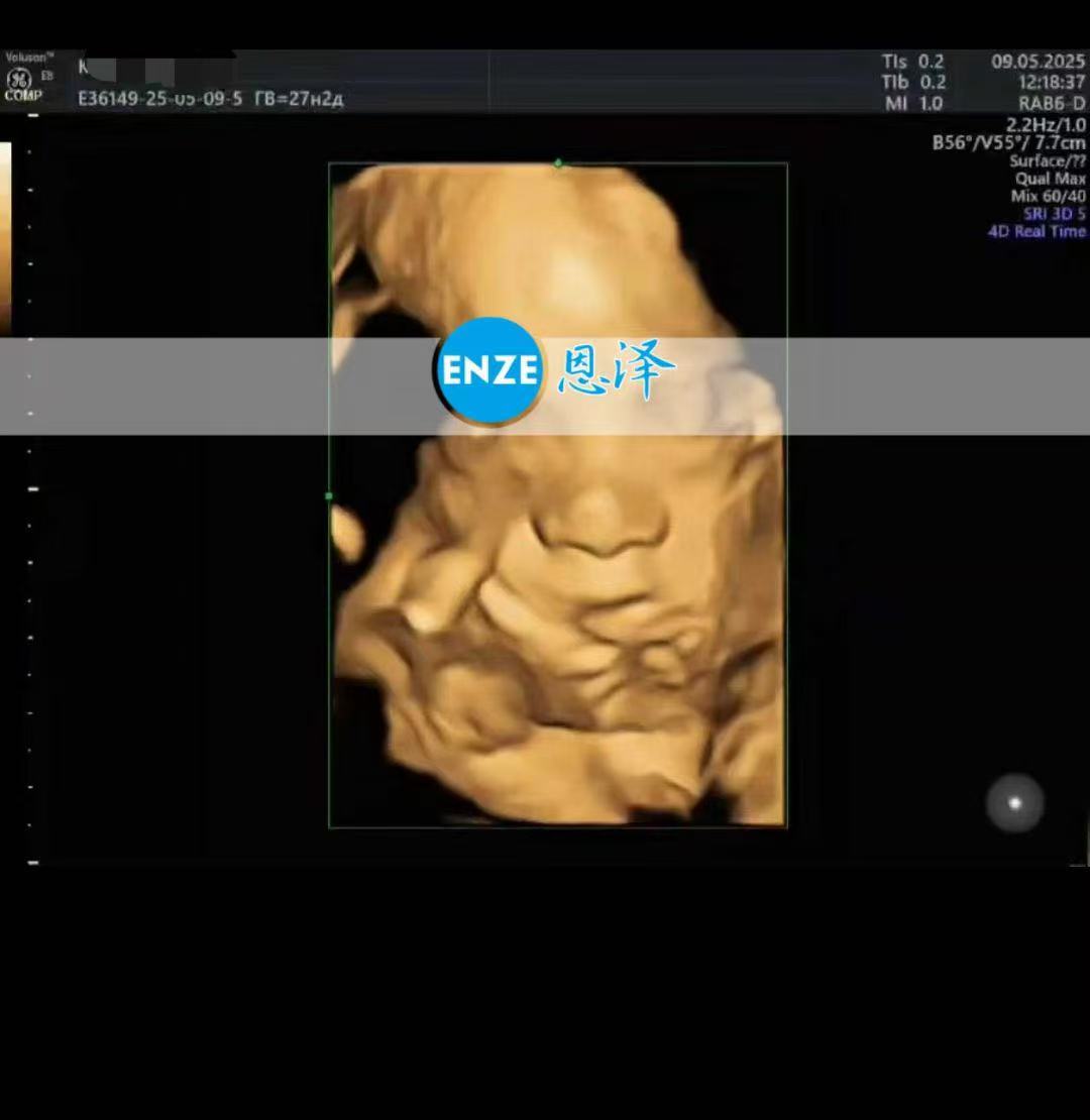 乌克兰试管婴儿助孕爱心使者27周产检顺利通过