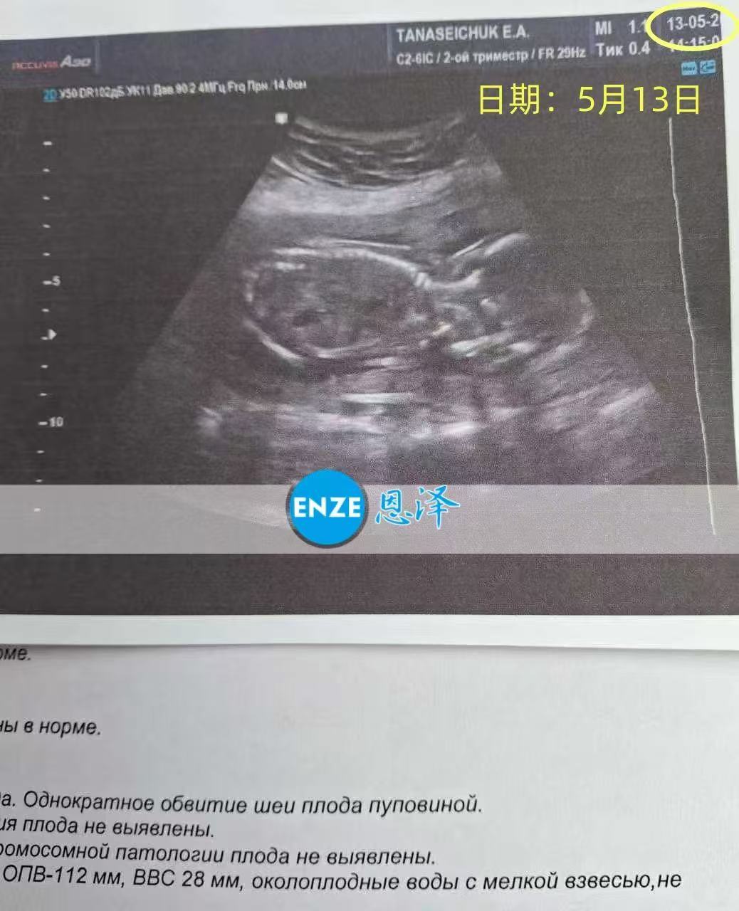 格鲁吉亚试管婴儿助孕爱心使者成功通过18周产检