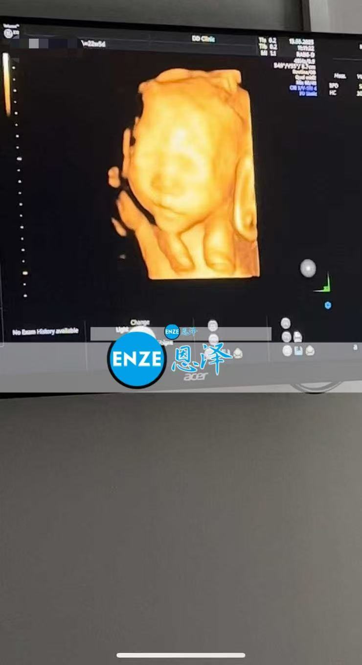格鲁吉亚试管婴儿助孕爱心使者22周产检顺利过关