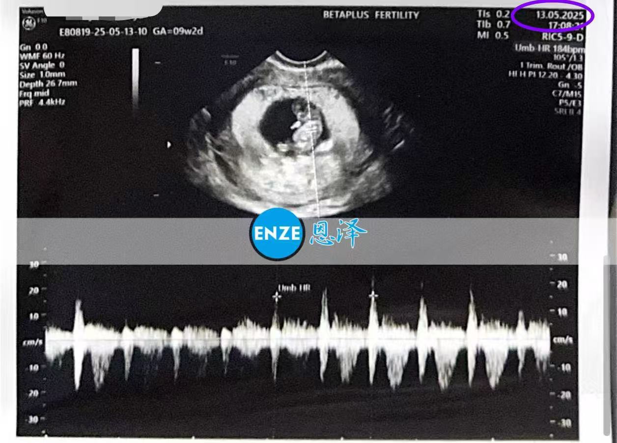 格鲁吉亚试管婴儿助孕爱心使者9周产检顺利过关