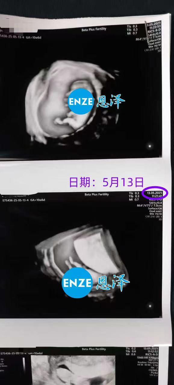 格鲁吉亚试管婴儿助孕爱心使者10周产检顺利通过