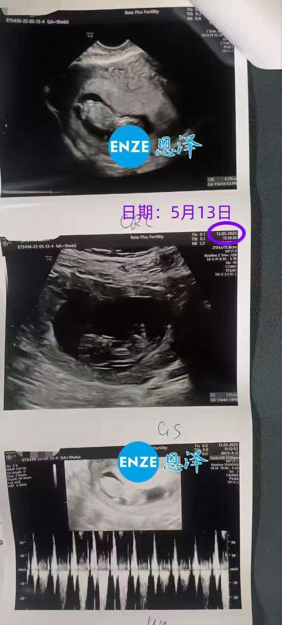 格鲁吉亚试管婴儿助孕爱心使者10周产检顺利通过