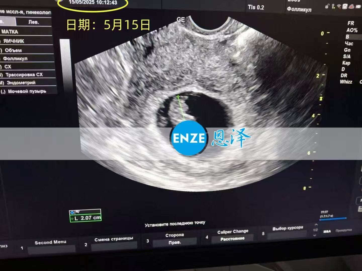 乌克兰试管婴儿助孕爱心使者16周产检顺利通过