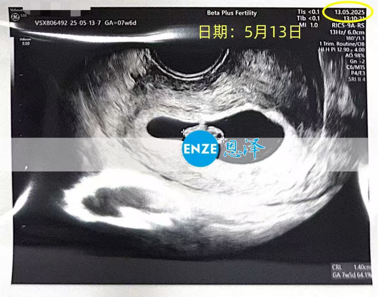 格鲁吉亚试管婴儿助孕爱心使者7周产检顺利过关