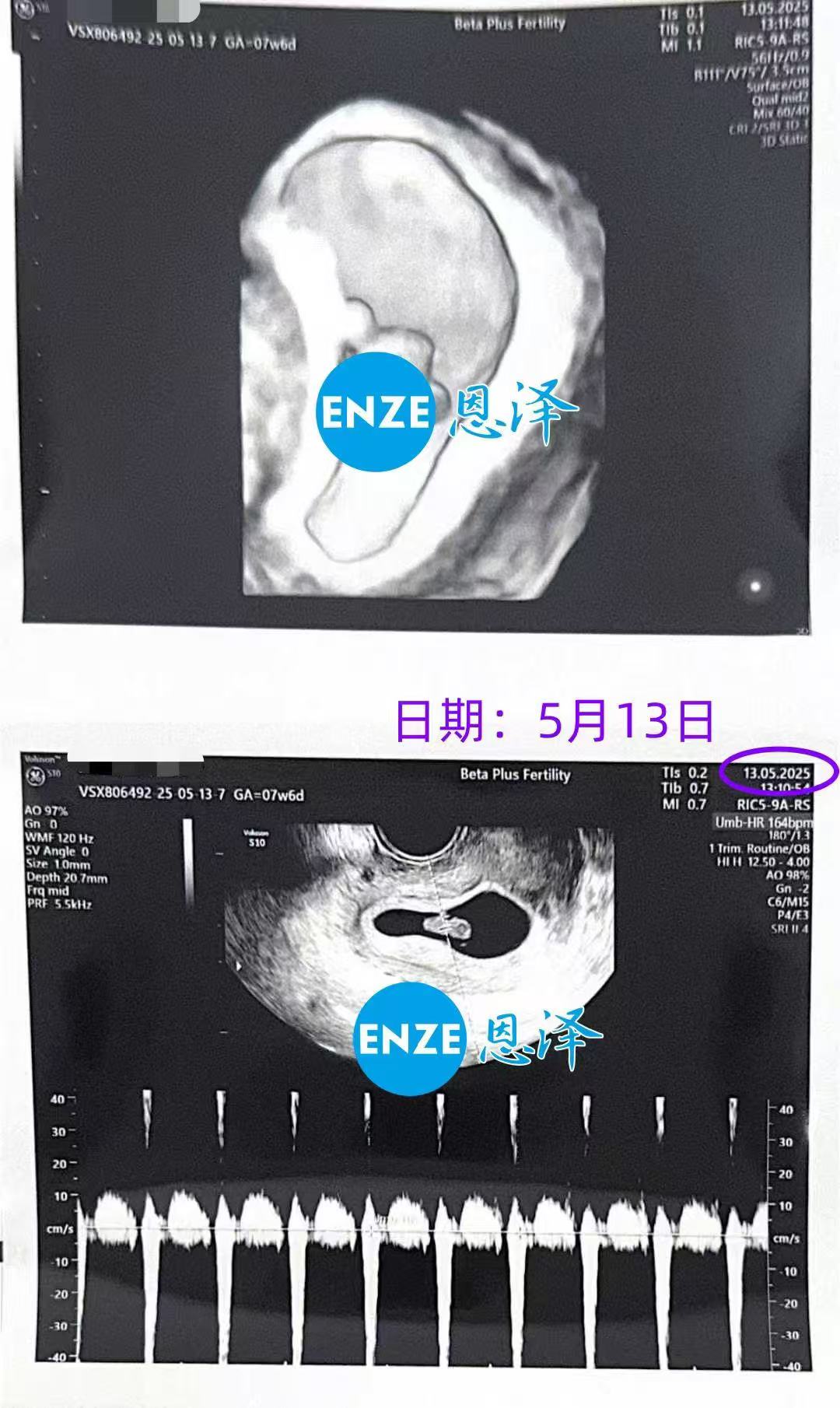 格鲁吉亚试管婴儿助孕爱心使者7周产检顺利过关