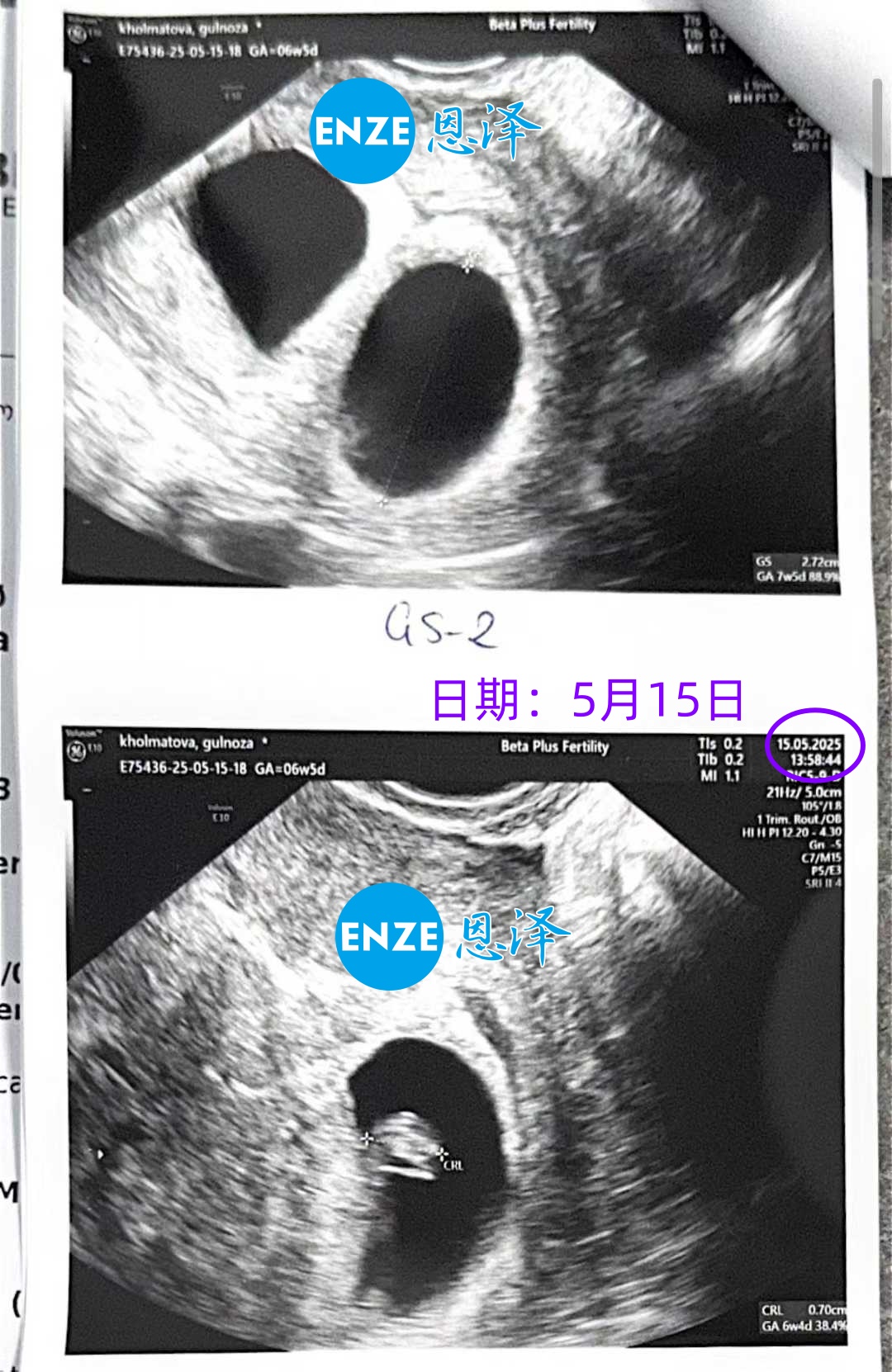 恩泽格鲁吉亚试管婴儿助孕爱心使者6周检查顺利通过