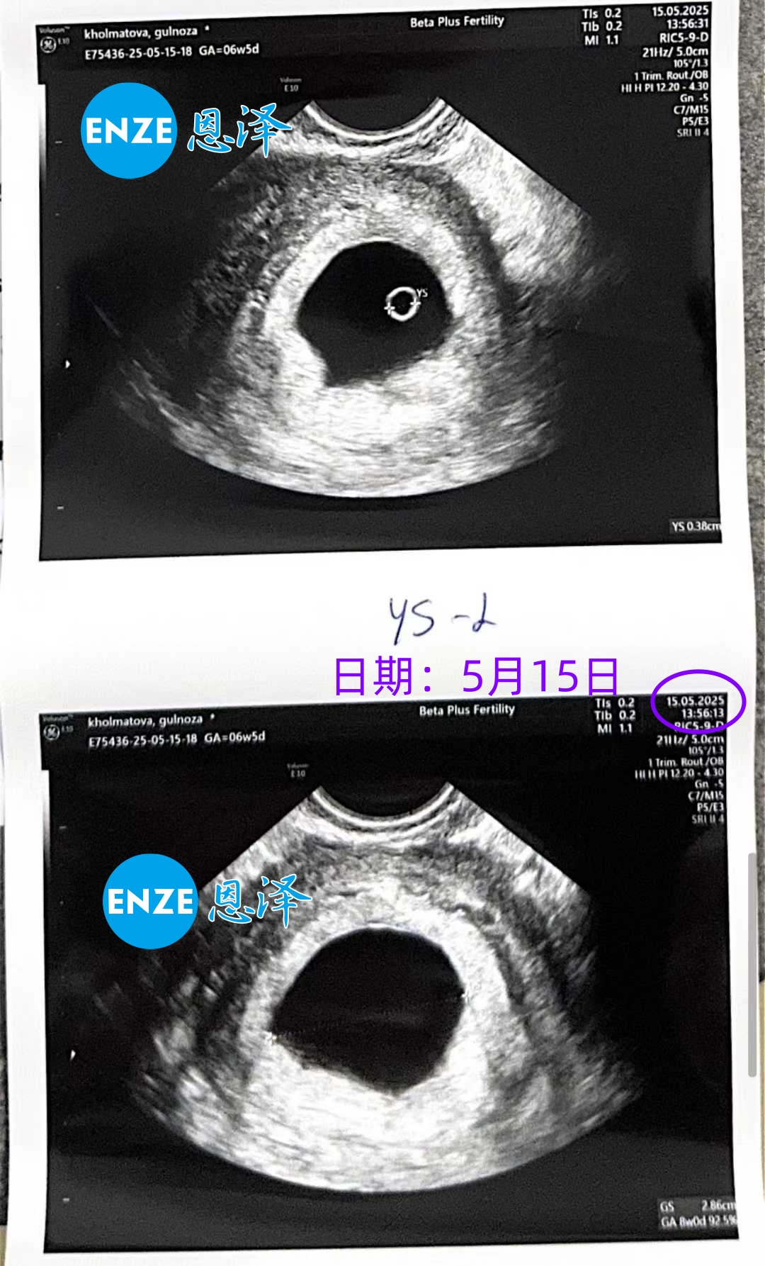 恩泽格鲁吉亚试管婴儿助孕爱心使者6周检查顺利通过