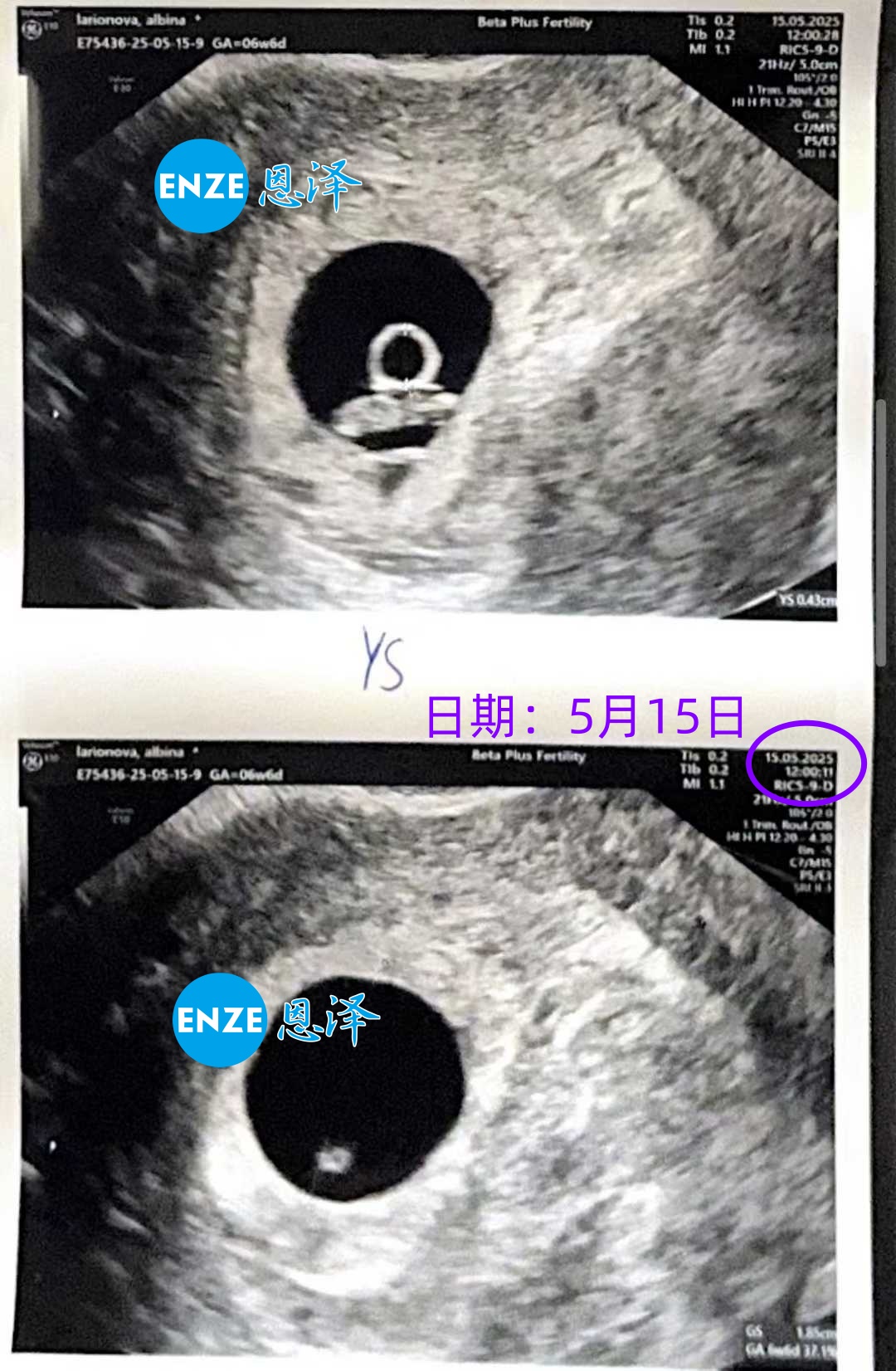 恩泽格鲁吉亚试管婴儿助孕爱心使者7周检查顺利通过