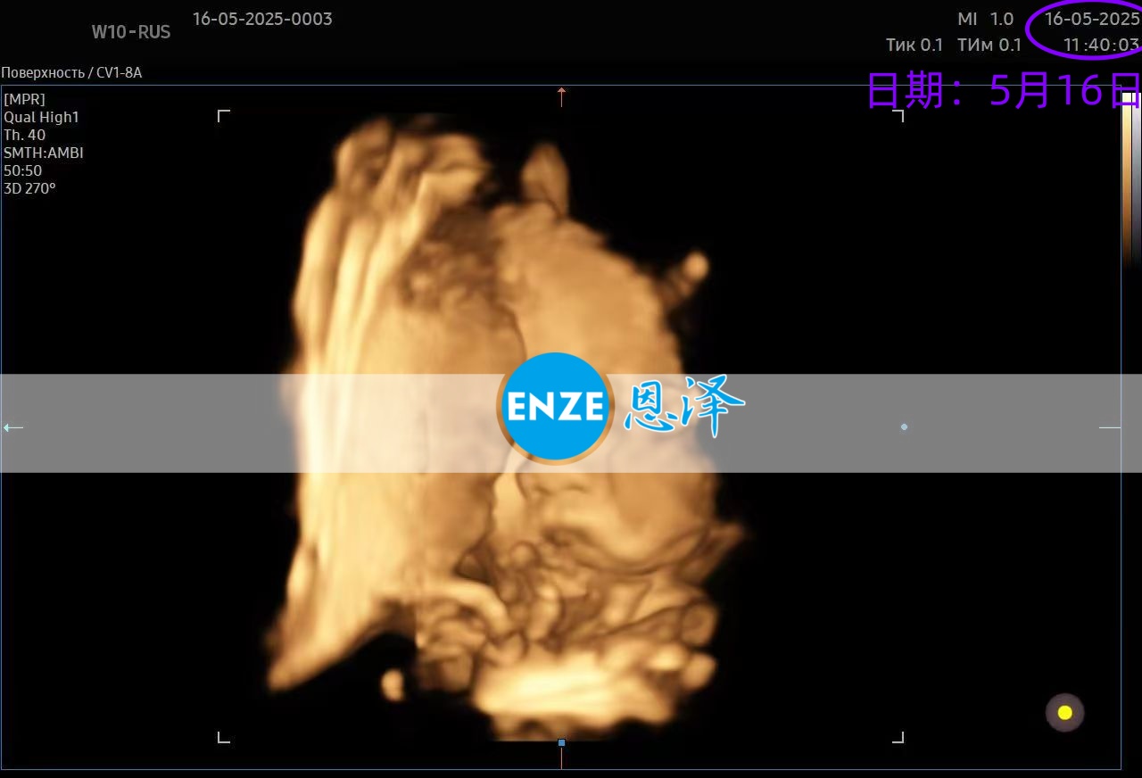 恩泽格鲁吉亚试管婴儿助孕爱心使者32周检查顺利通过