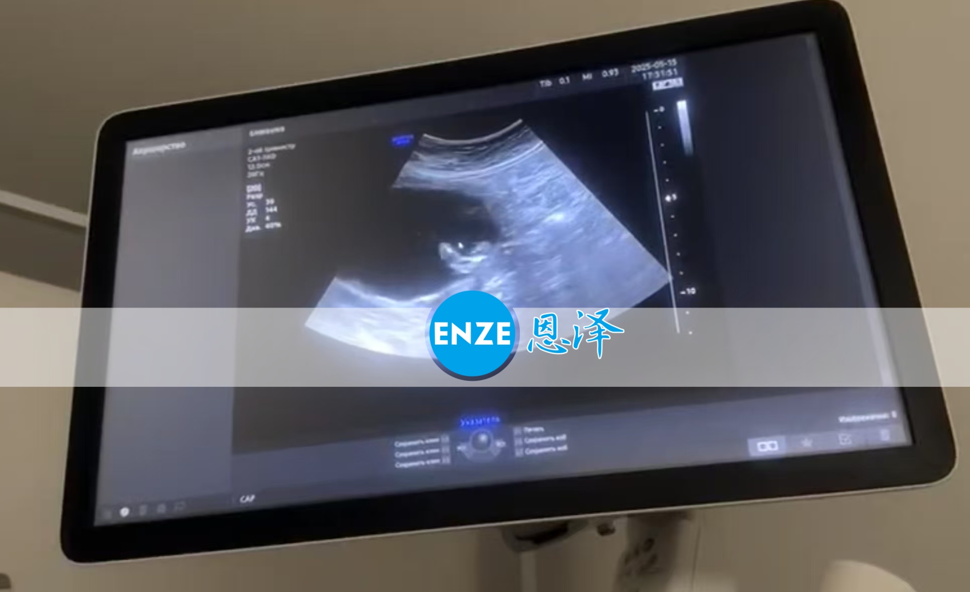 恩泽格鲁吉亚试管婴儿助孕爱心使者18周检查顺利通过